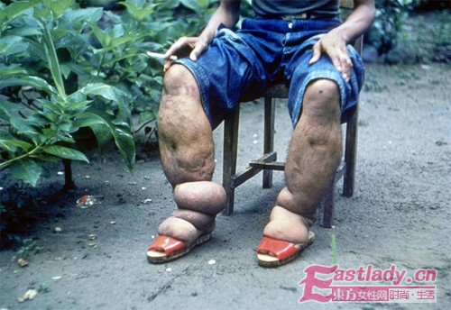 1，象皮病。患有这种病的病人的腿和胳膊会显得非常肿胀。这种病可能是由蚊子传染导致的，全球大约有1200万的患者。