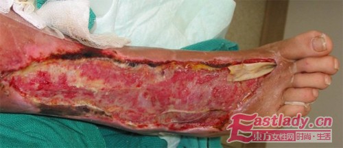 7，坏死性筋膜炎。这是一种很严重的病，这种病是由于食用了糟糕的食物。患有这种病的病人的皮肤好像腐烂一样。