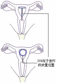 各種節育環的種類圖片介紹