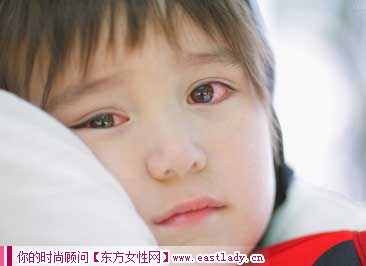 红眼病的症状治疗用什么药