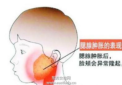 流行性腮腺炎的預防方法大全