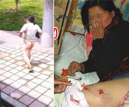女子草丛小便遭恶狗撕咬 治病花万元犬主耍赖