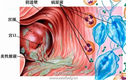 婦科疾病