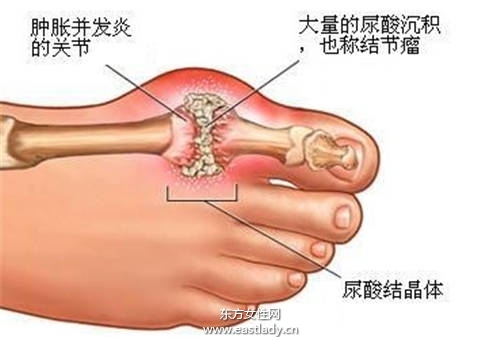 晚上关节突然痛得不得了?有可能是患有痛风的症状_痛风的症状_痛风不能吃什么_痛风如何治疗