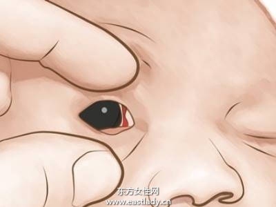宝宝眼白呈现异色时 应及早就医检查
