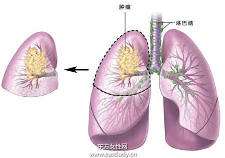 肺癌切勿寻求偏方 而延误治疗时机