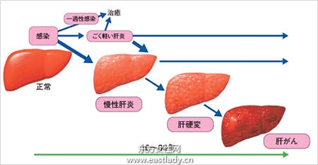 男性肥胖酗酒 恐成肝癌主因