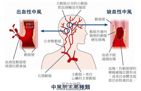 婦人突然腦中風居然是甲狀腺亢進所致