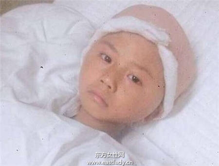 感动！父亲意外严重烧伤 年幼兄妹自愿捐头皮