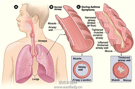 COPD患者咳嗽易误当感冒