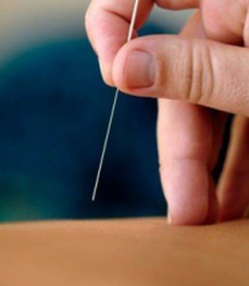 针刺疗法,耳穴针刺热控减肥的具体方法