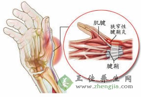 腱鞘炎怎麼治療 熏洗法治療腱鞘炎