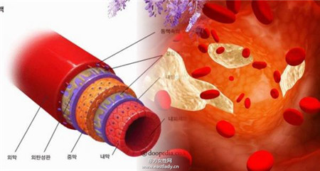 血管硬化怎么办 6 种方法能够帮血管洗澡