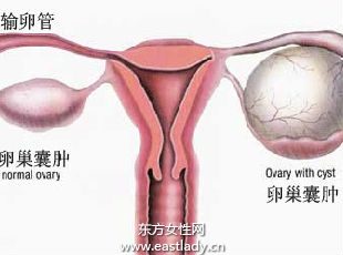 月經不來＋暴肥 妙齡女罹多囊卵巢
