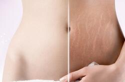 妊娠纹怎么消除 揭密祛除妊娠纹最好的方法