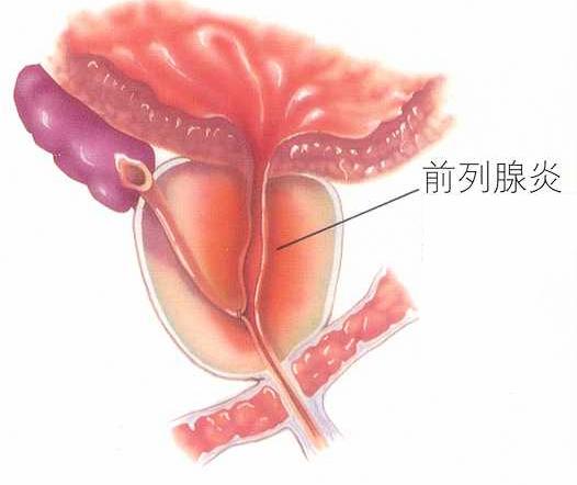 前列腺炎會不會傳染