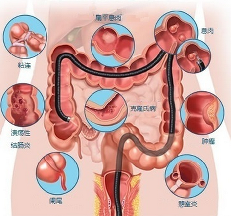 腸鏡檢查