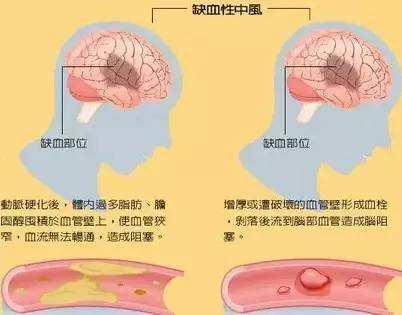 轻微脑梗塞