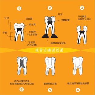 牙齿根管治疗过程 根管治疗步骤