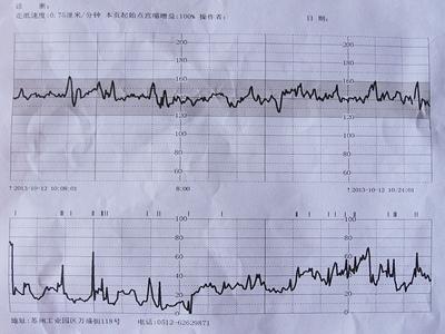 胎心监护