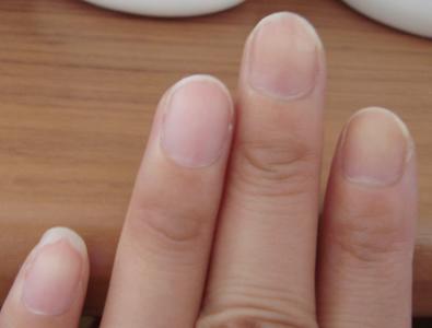 灰指甲怎么治疗，怎么还原指甲本色？