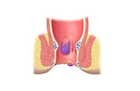 内痔疮的最佳治疗方法