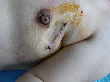 高发的妇科疾病 乳腺结节是怎么回事