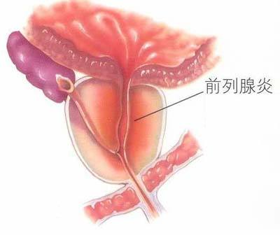 前列腺炎怎么治疗