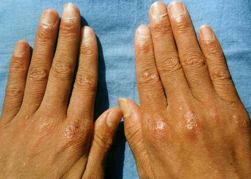 4种皮肌炎的症状及皮肌炎的护理的介绍