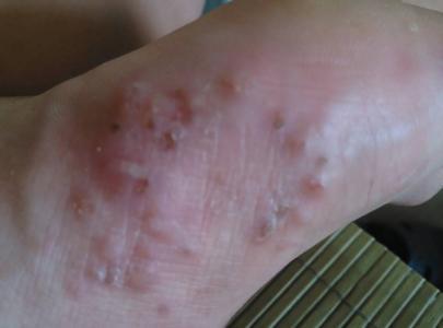 脚上长水泡很痒应该如何预防和治疗