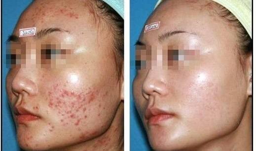 暗疮的最佳治疗方法以及暗疮的预防措施