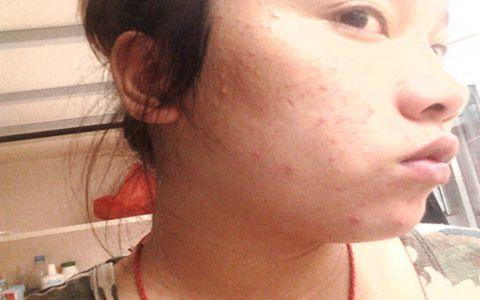 如何去除脸上痤疮 根据个体的体质治疗痤疮