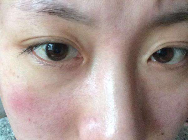面部发红怎么办 几个细节呵护皮肤过敏