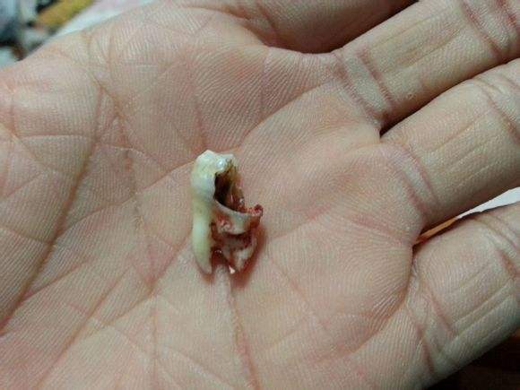 拔智齿后吃什么 拔牙虽小可也有讲究的