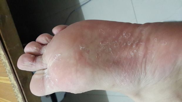 脚底脱皮是什么原因 几个因素导致脚底脱皮