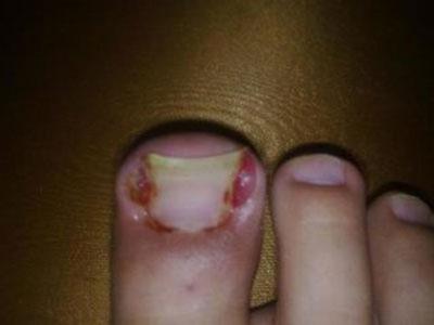 脚趾甲沟炎怎么治 脚趾甲沟炎治疗有偏方