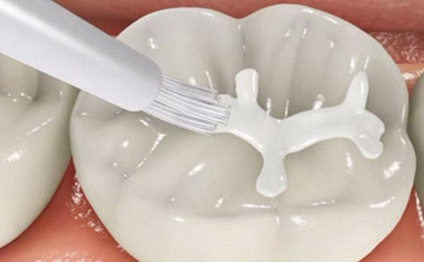 什么是窝沟封闭 是一种口腔的技术防止牙齿受到侵蚀