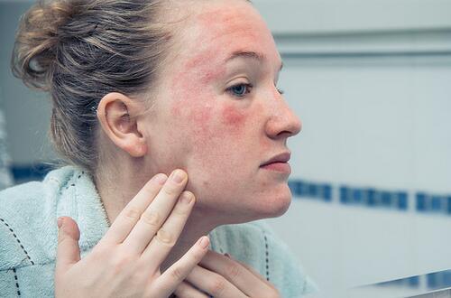皮膚發紅怎麼辦   治療和預防相結合