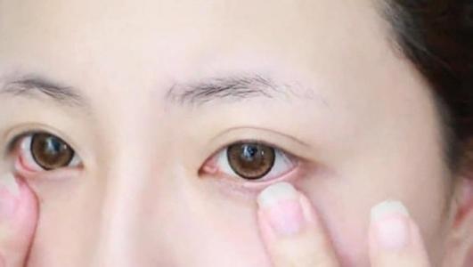 怎样减少眼袋，小编分享分享改善方法