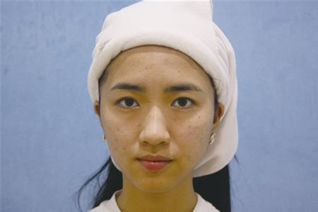 祛除痘印痘坑 四个小窍门轻松去痘印