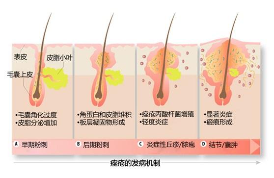 长痤疮了怎么办