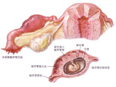 对女危害极大宫外孕是什么症状你知道吗