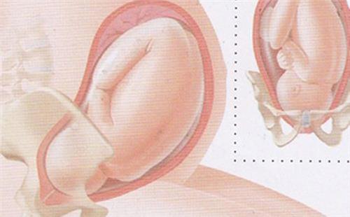 胎儿不入盆 使胎儿快速入盆的方法