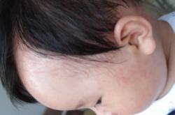 幼儿急疹注意事项 幼儿急疹会传染吗