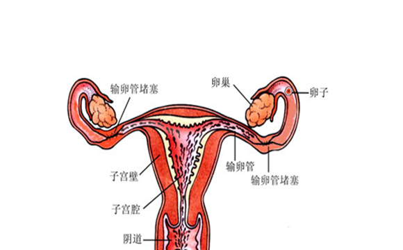 输卵管堵塞怎么办 输卵管堵塞的预防