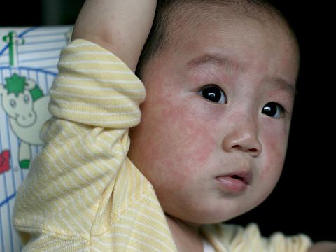 婴儿急疹的临床症状以及它的治疗方法