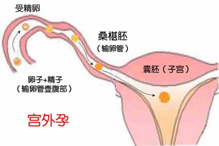 宫外孕症状 怀孕时出现以下症状需及时就医