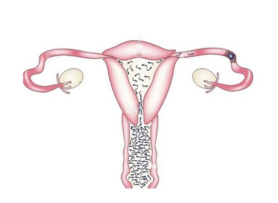 输卵管阻塞怎么治以及能吃什么