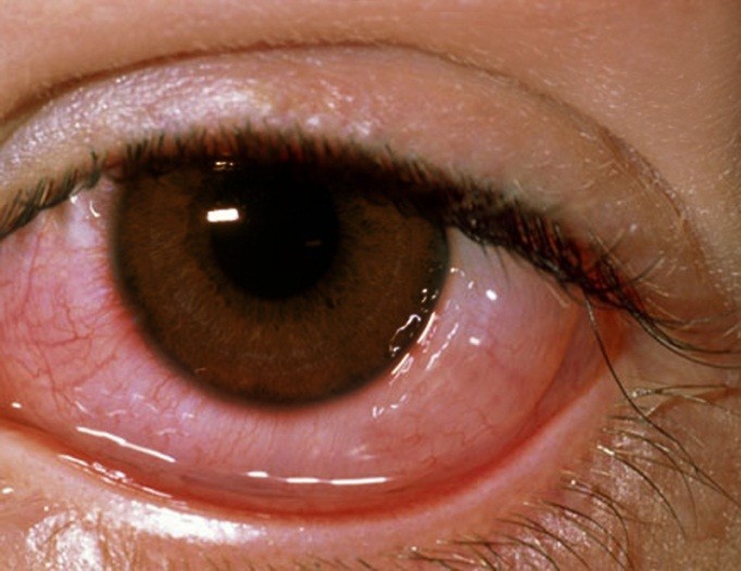 红眼病治疗方法 不同类型的红眼病的治疗方法