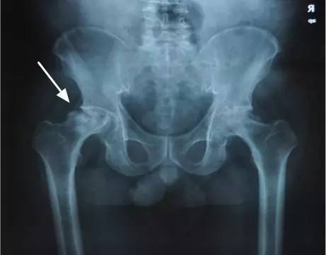 股骨头坏死的主要症状表现以及它的治疗方法